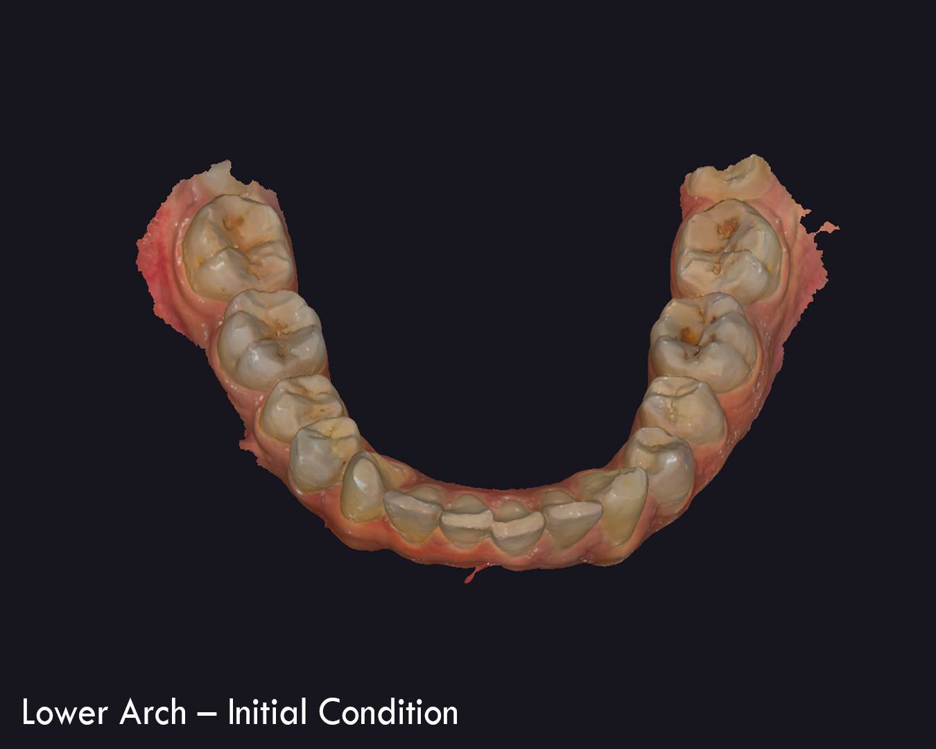 Lower arch, initial condition