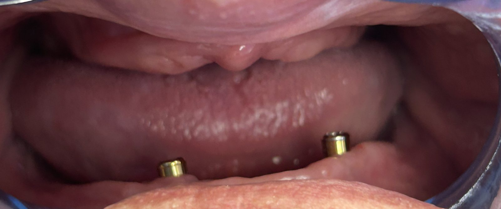 Clinical situation: two existing implants with attachments